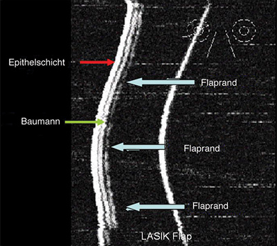 Femto-Laser Laserschnitt